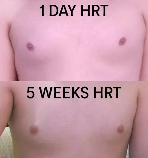 Leca 5 weeks estrogel