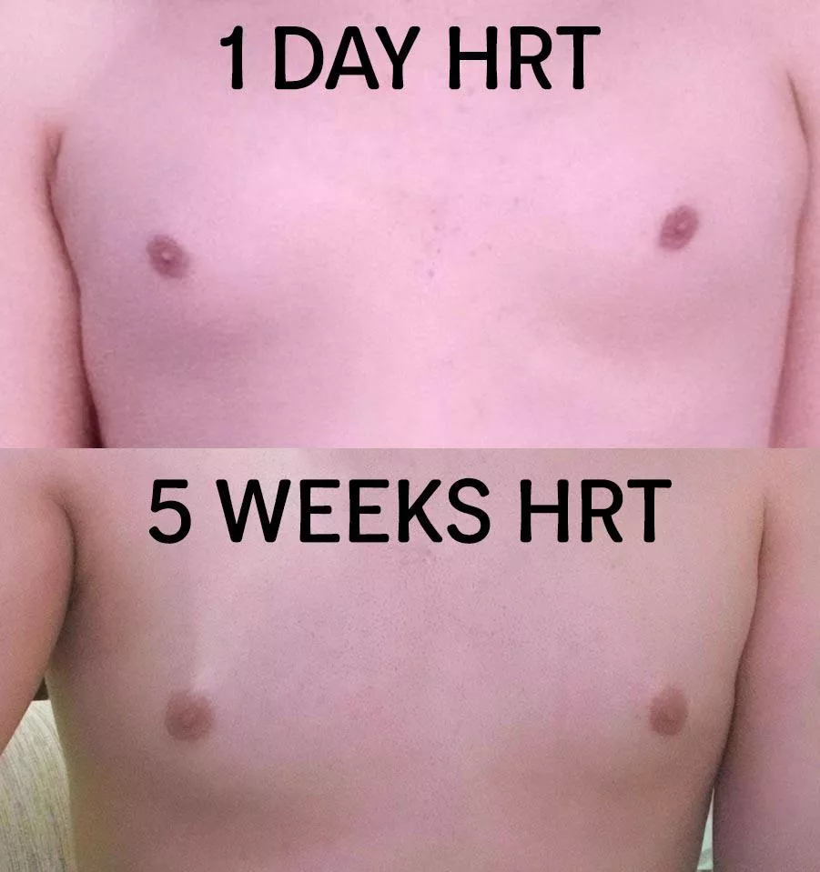 Leca 5 weeks estrogel