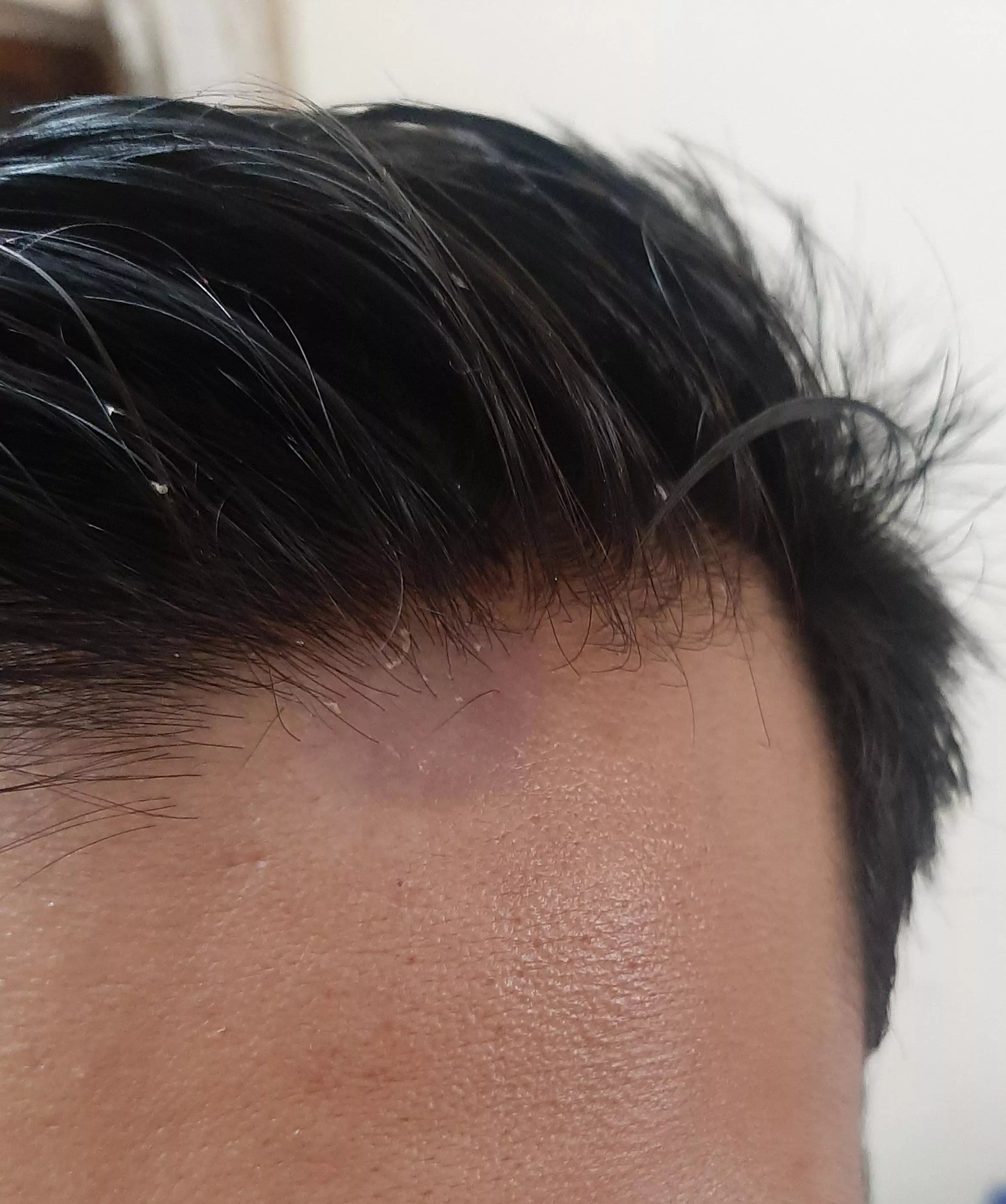 Notice this brown spot on my hairline . Some skin is peeling/shredding as you can see. No itching. Should i be concerned?
