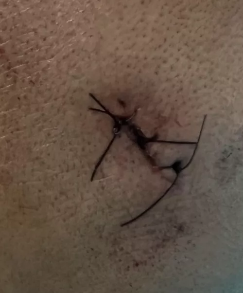 Sorry as I never had surgery before, is this a normal stitch job? (pic was taken before gauze/bandage was put for cyst removal)