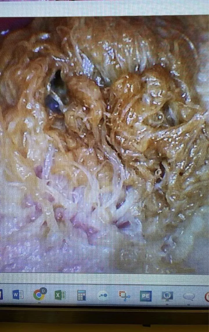 A condition called “Hairy Tongue”