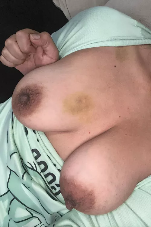  Bruises are a sign he enjoyed his meal 