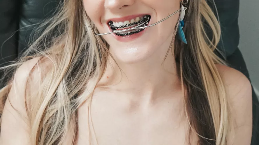 Do you like my smile? Even with all the hardware