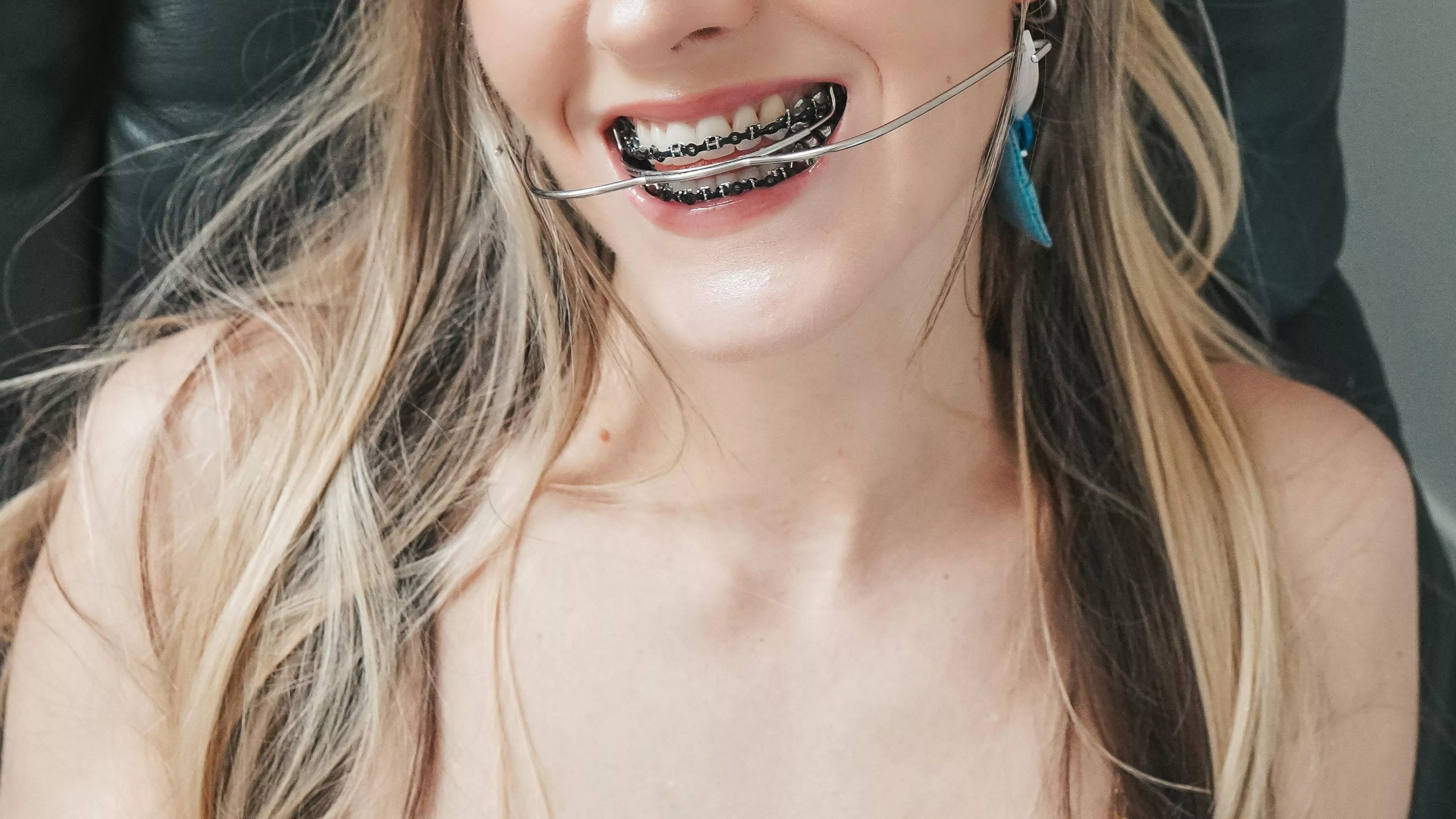 Do you like my smile? Even with all the hardware