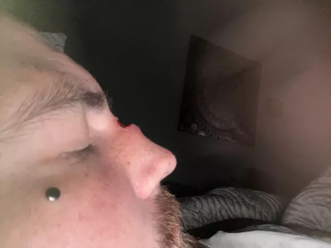 Fell down stairs….