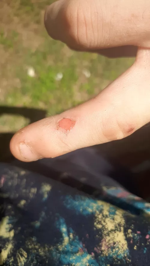 My finger was itchy last night