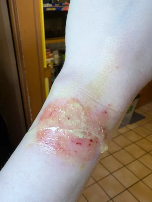 Smartwatch rash + fresh aloe vera from the garden = body horror