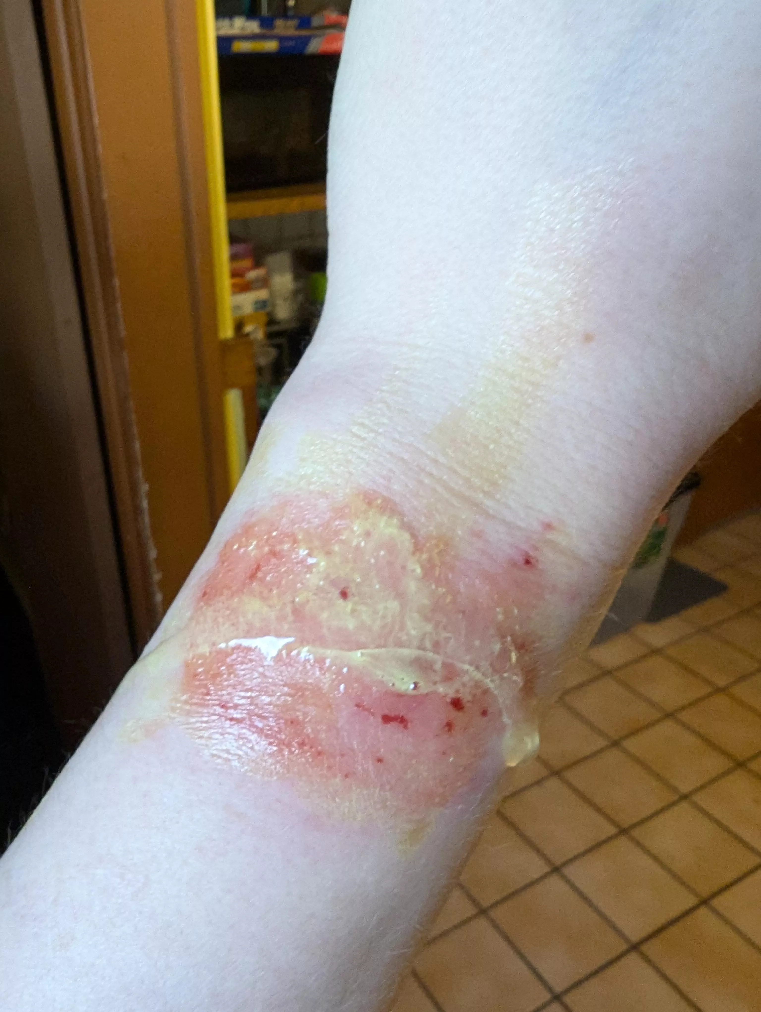 Smartwatch rash + fresh aloe vera from the garden = body horror