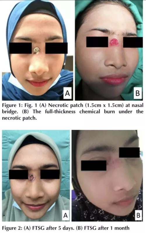 A woman attempted mole removal with an “unauthorized” cream made of cinnamon, lemon juice and vitamin E. Result: chemical burn and necrosis. The necrotic patch got bigger than the original mole had been and she needed surgery and a skin graft.
