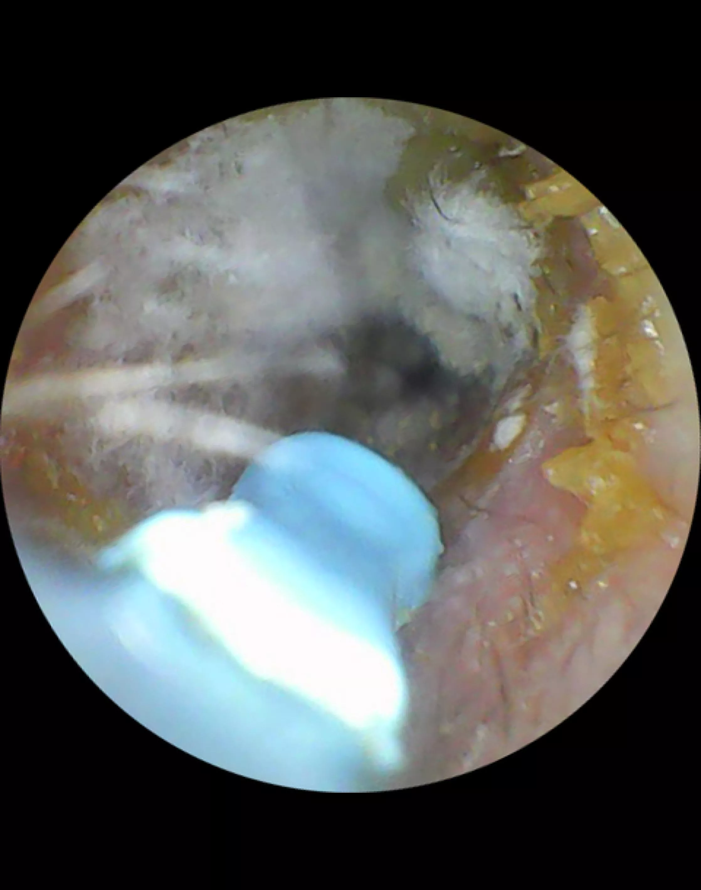 Is this mould?looking in my partners ear and it was this fluffy texture. No Q tip used. 