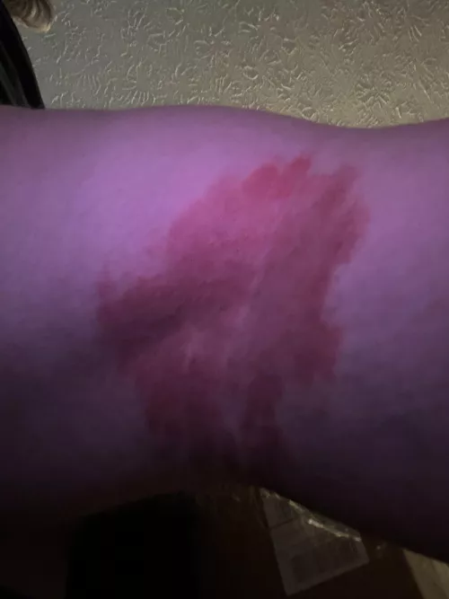 Any solutions on getting rid of this? It doesn’t hurt or anything it just itches a little every couple days and the skin is real rough. The pretty sure it’s just from sitting with my one leg crossed a lot