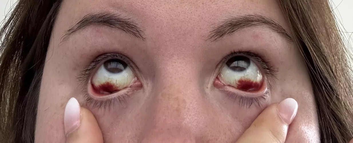 Burst blood vessels?