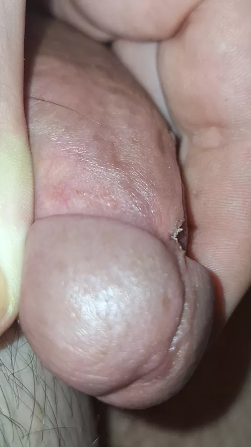 Frenulum snipped