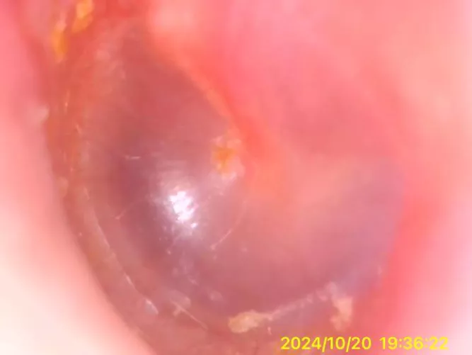 Is there anything wrong with this ear? I’ve been having some pain, and lots of tenderness in the canal. Also have a swollen lymph node below my jaw. Not sure if it’s all linked, or what it could be