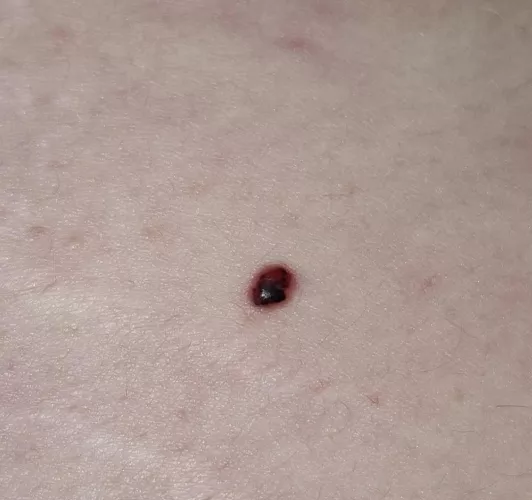 Noticed a mole on my back turned to this and it hurts, I'm going to the doctor tomorrow.