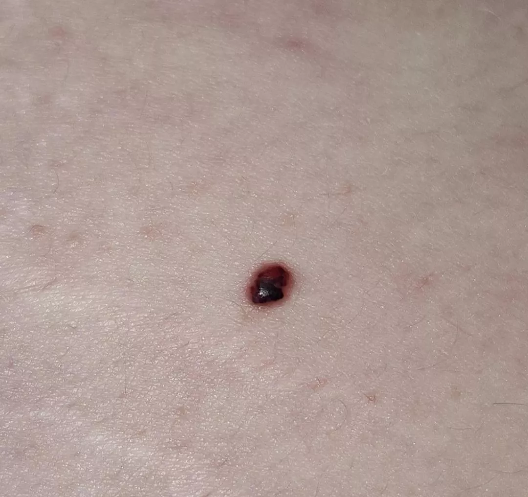 Noticed a mole on my back turned to this and it hurts, I'm going to the doctor tomorrow.