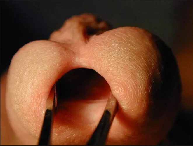 Partial meatotomy open