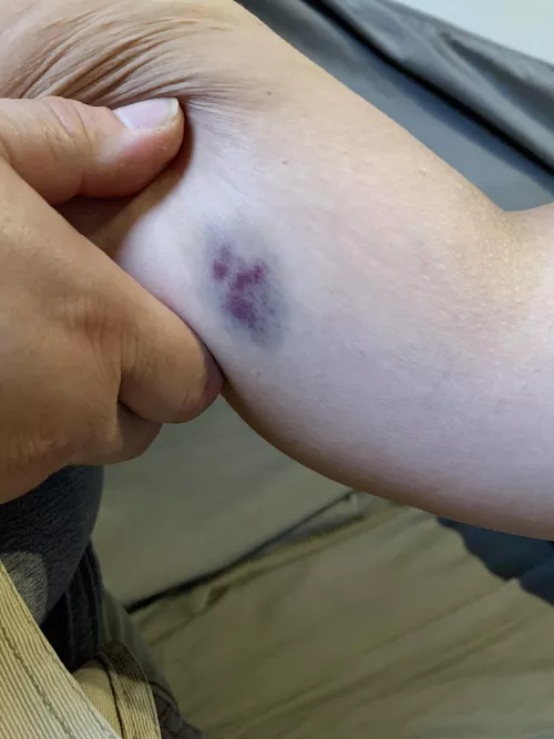 Strange bruise