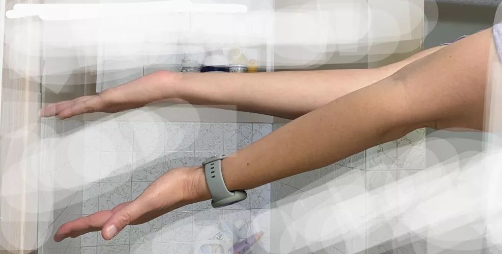 WWYD elbow injury (urgent care said broken, surgeon said no but didn't take new x rays)