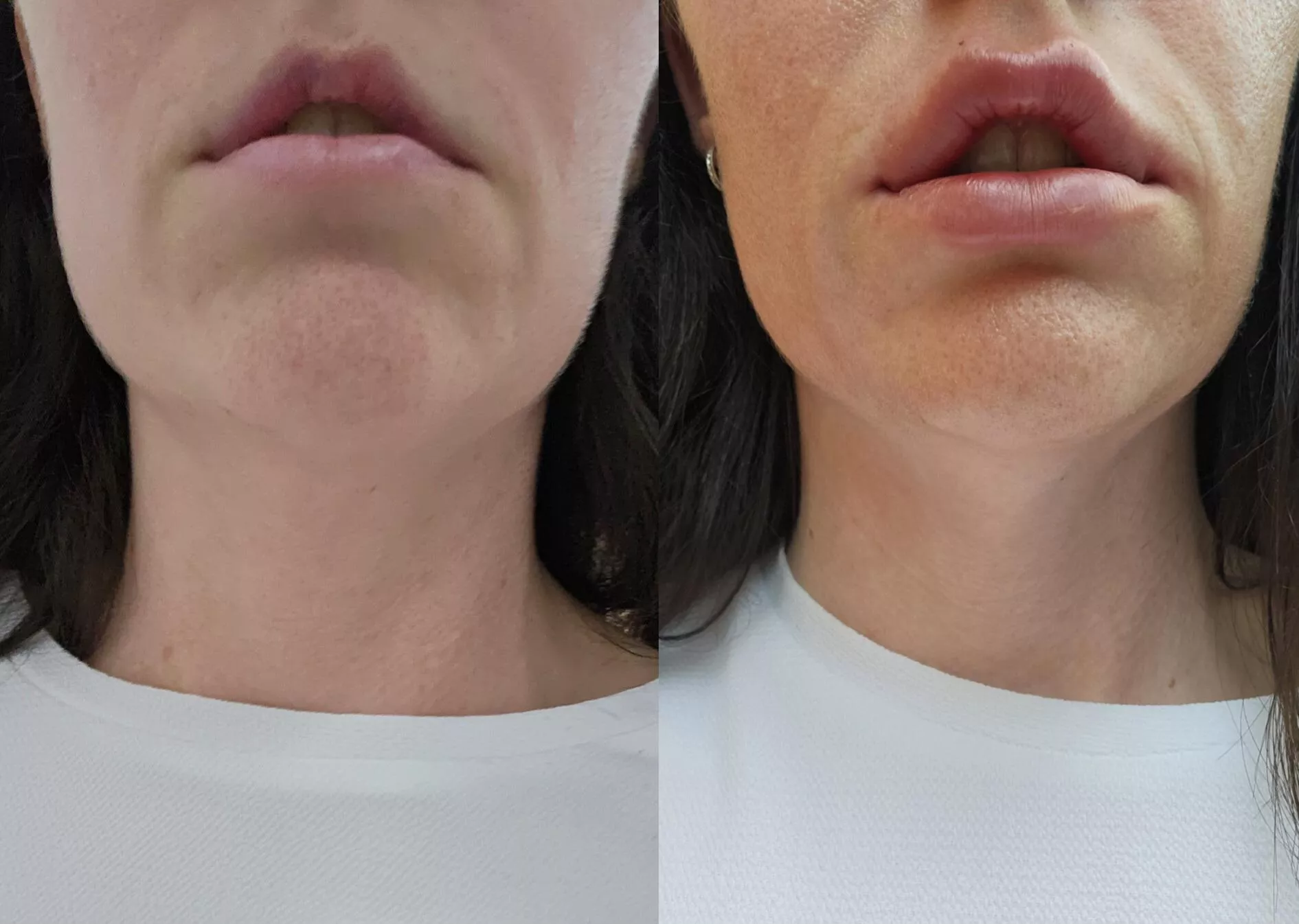 BS made me desperate to fill my lips