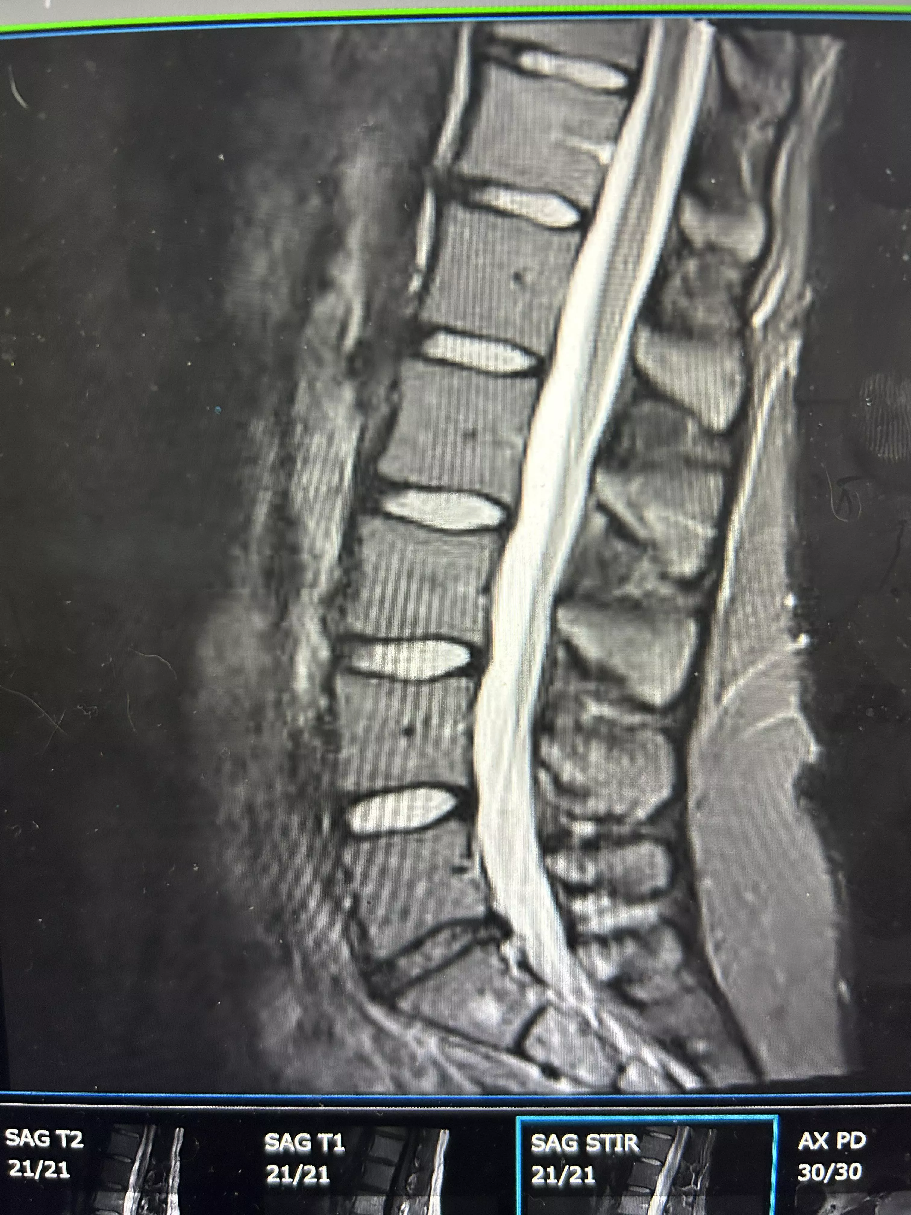 Is my weight gain why my back hurts so bad?