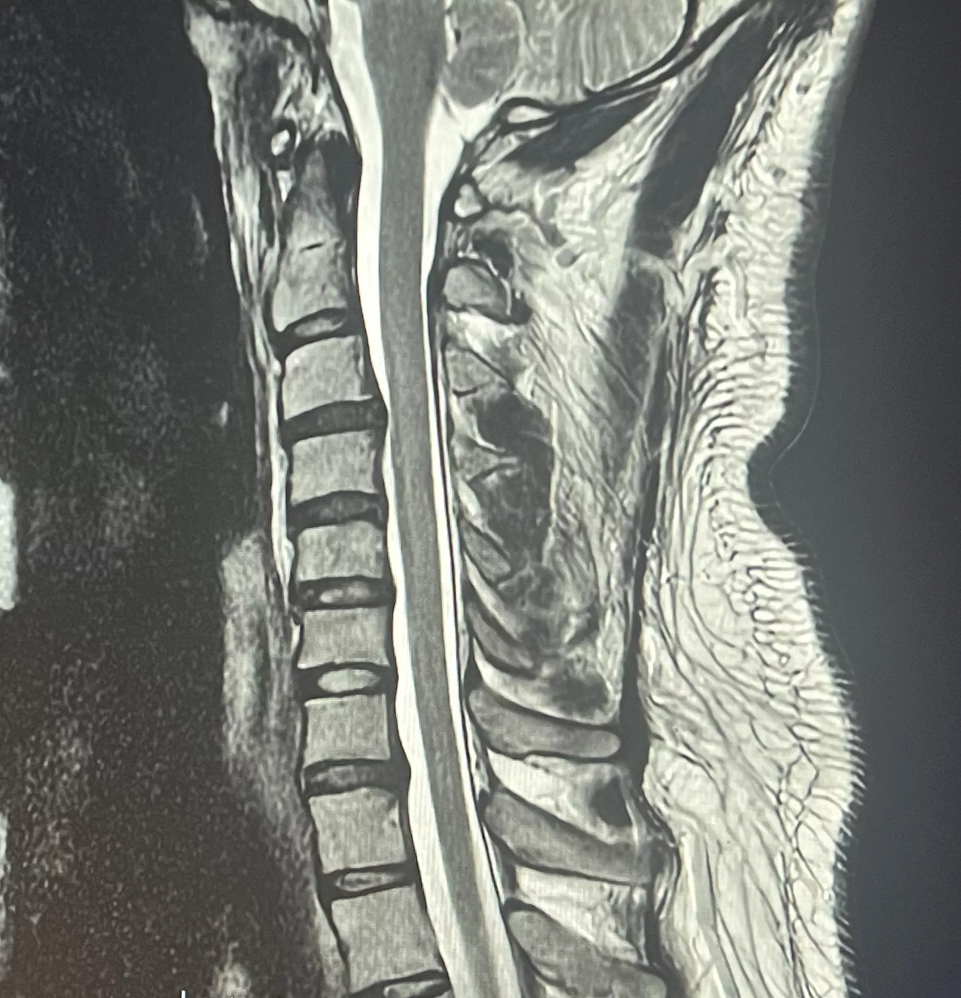 My interesting Cervical Spine disc bulges