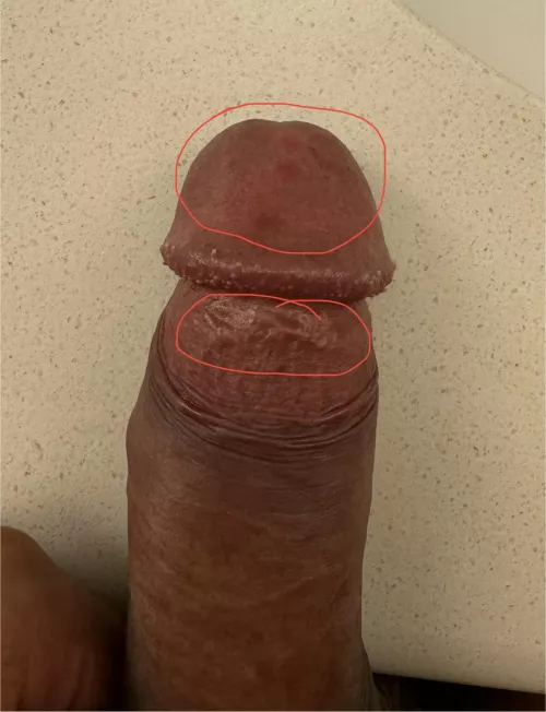 Red/purple dots on penis