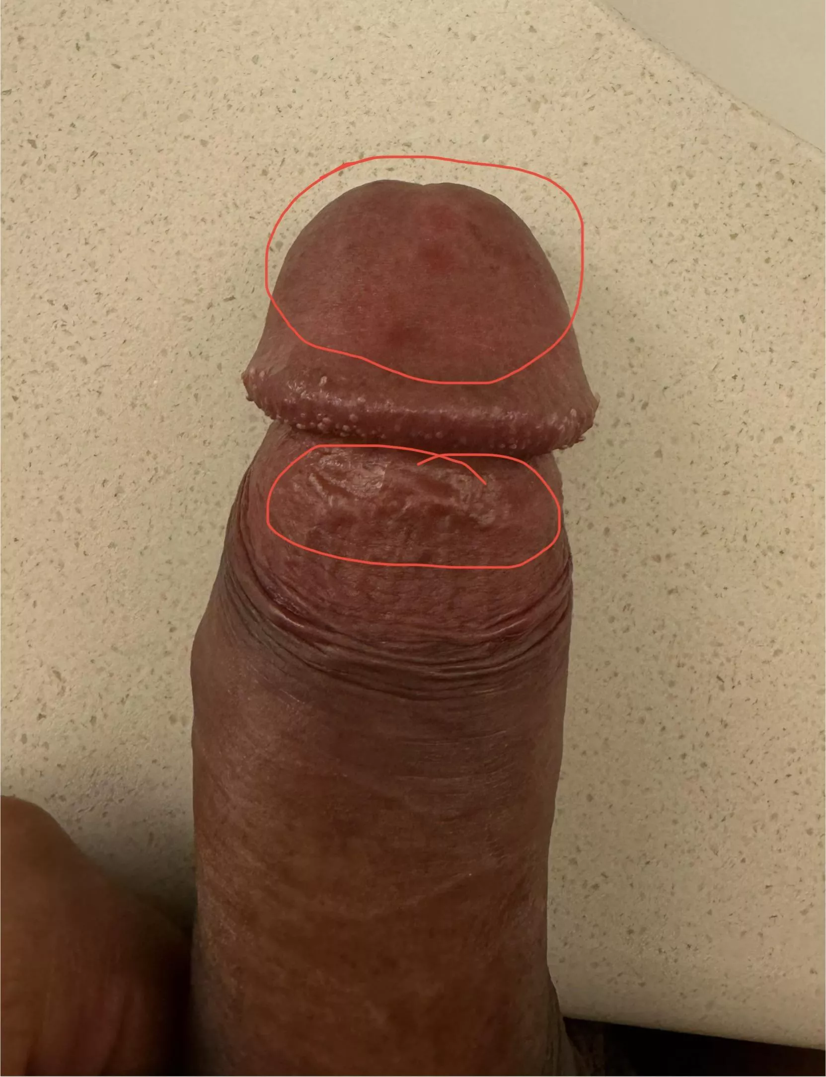 Red/purple dots on penis