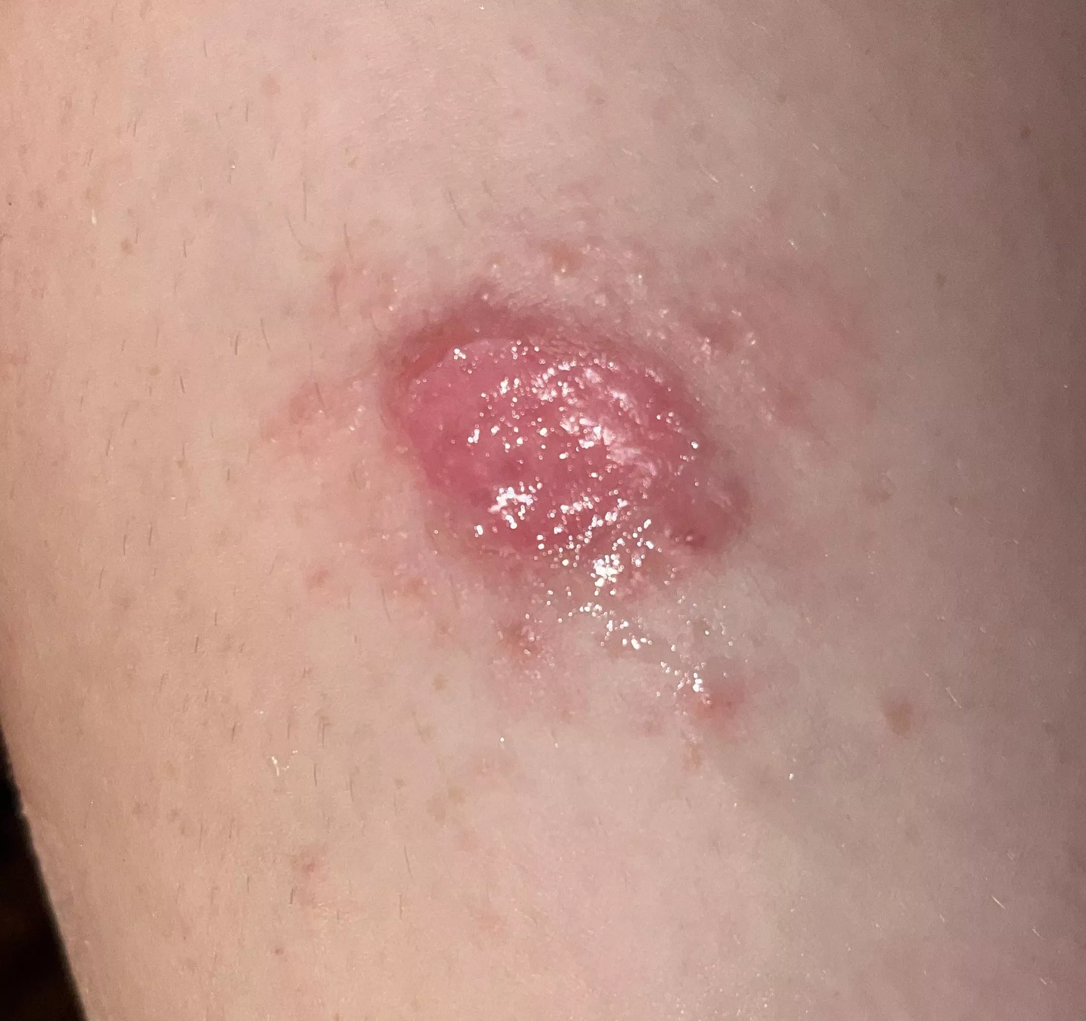 Nitrous burn from whippet tank 