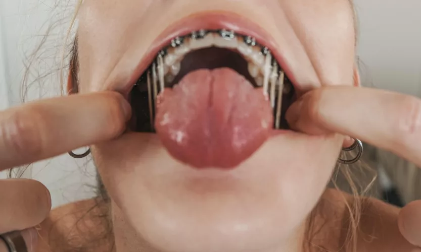 Try not snap my elastics because that really hurts