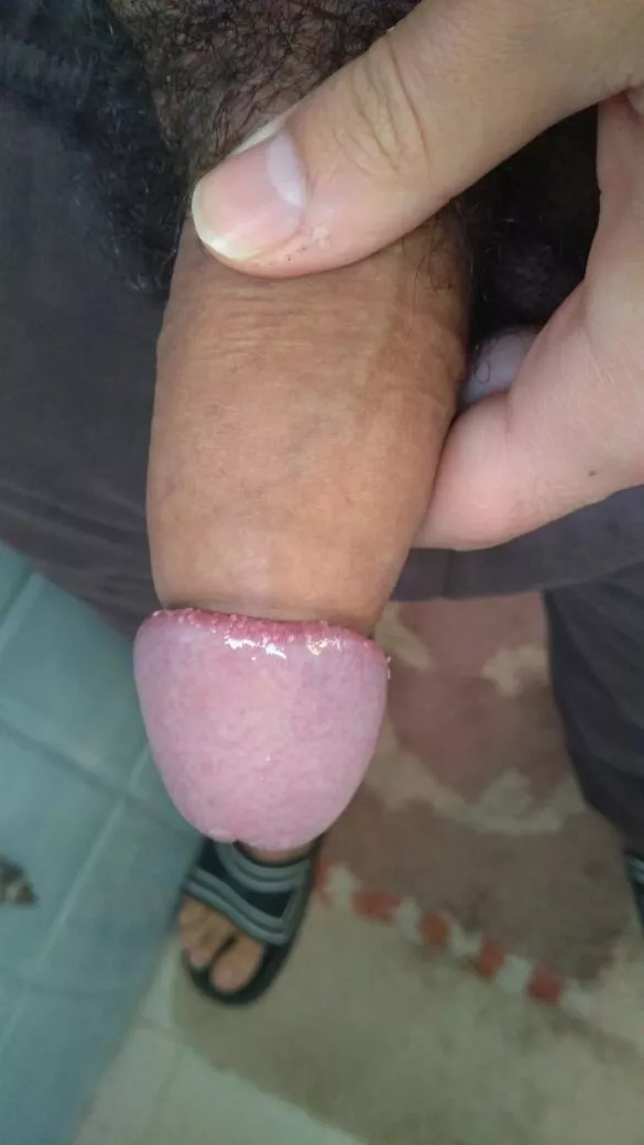 When my phimosis was really really intense! By the way it doesn't hurt as shown and it also gets very very sensitive! 