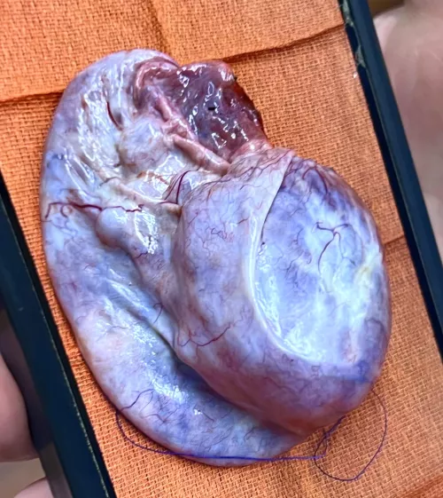 Basketball sized ovarian cyst 🏀