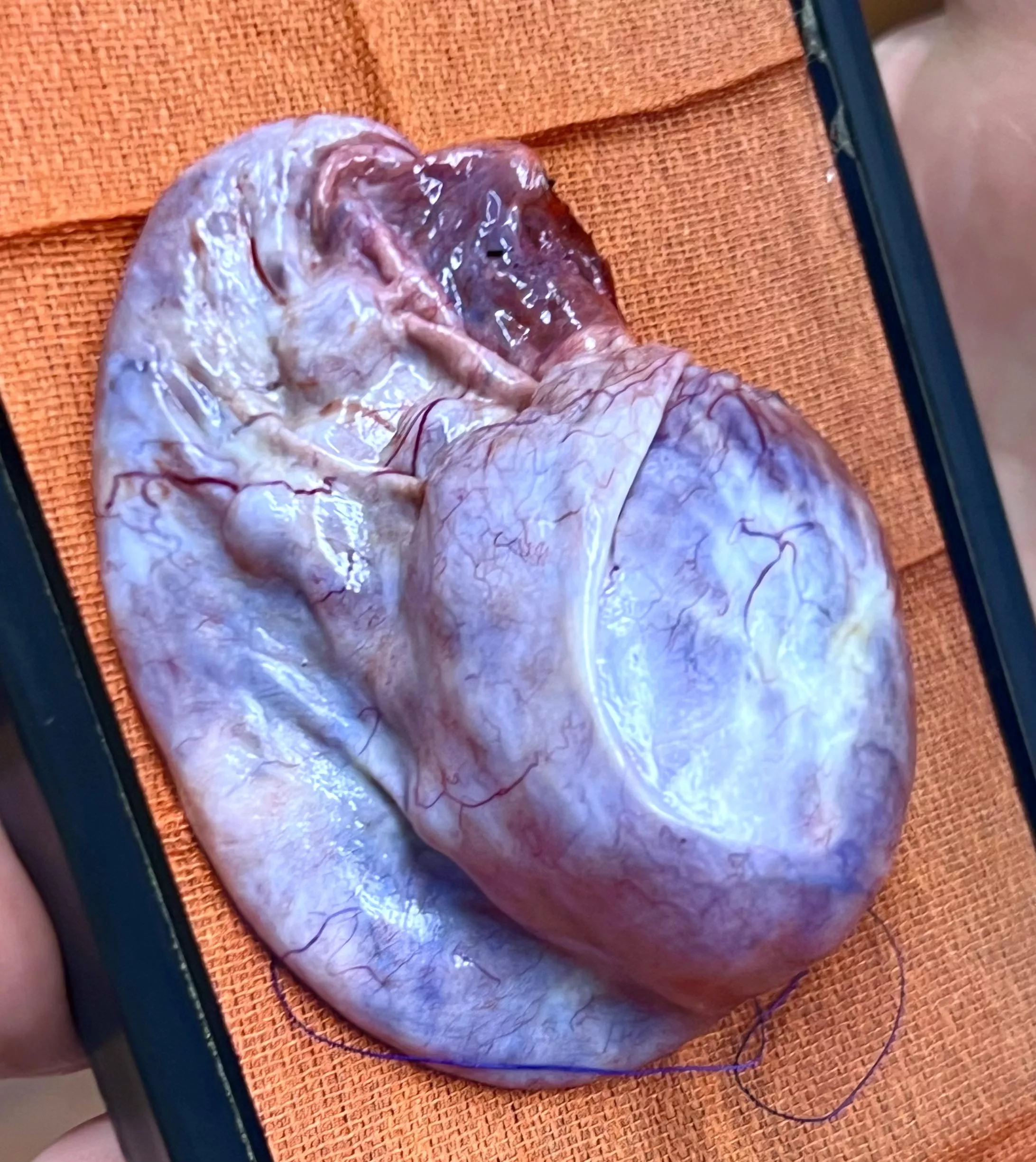 Basketball sized ovarian cyst 🏀