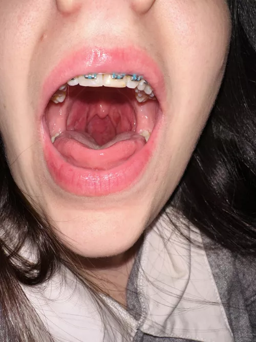 I hope my little dessert doesn't get stuck in the braces