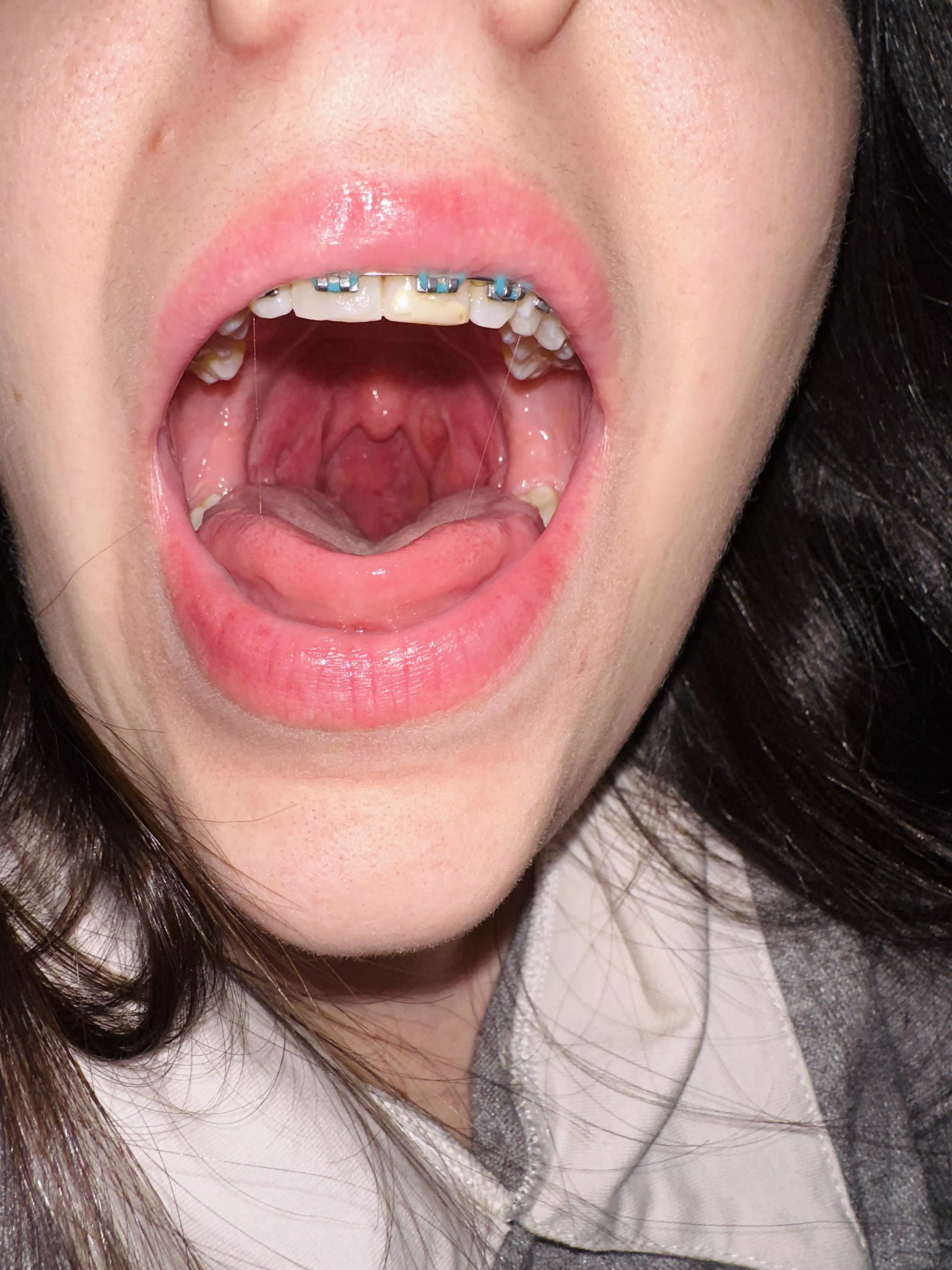 I hope my little dessert doesn't get stuck in the braces