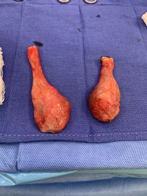 Just come out of surgery 