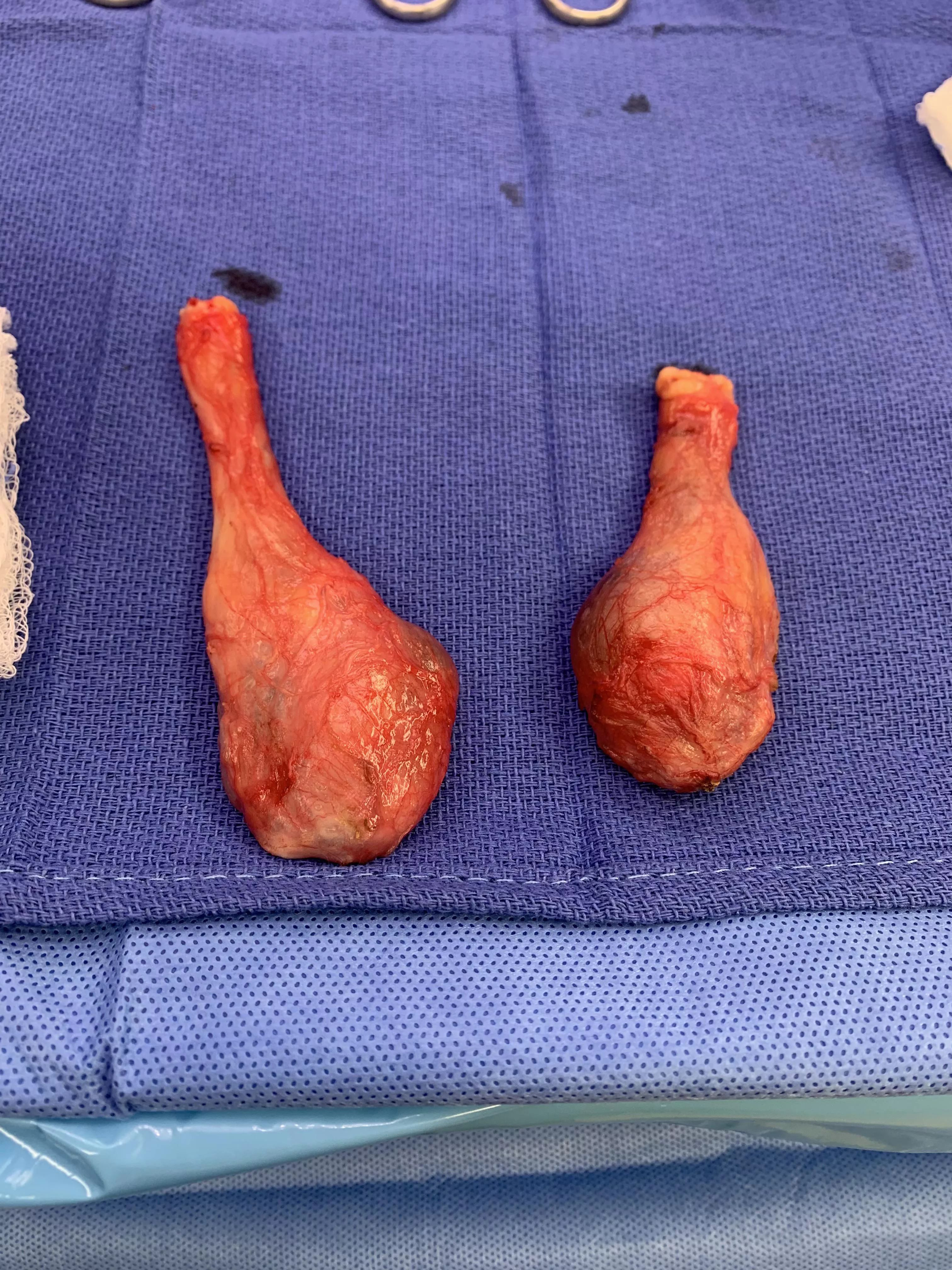 Just come out of surgery 