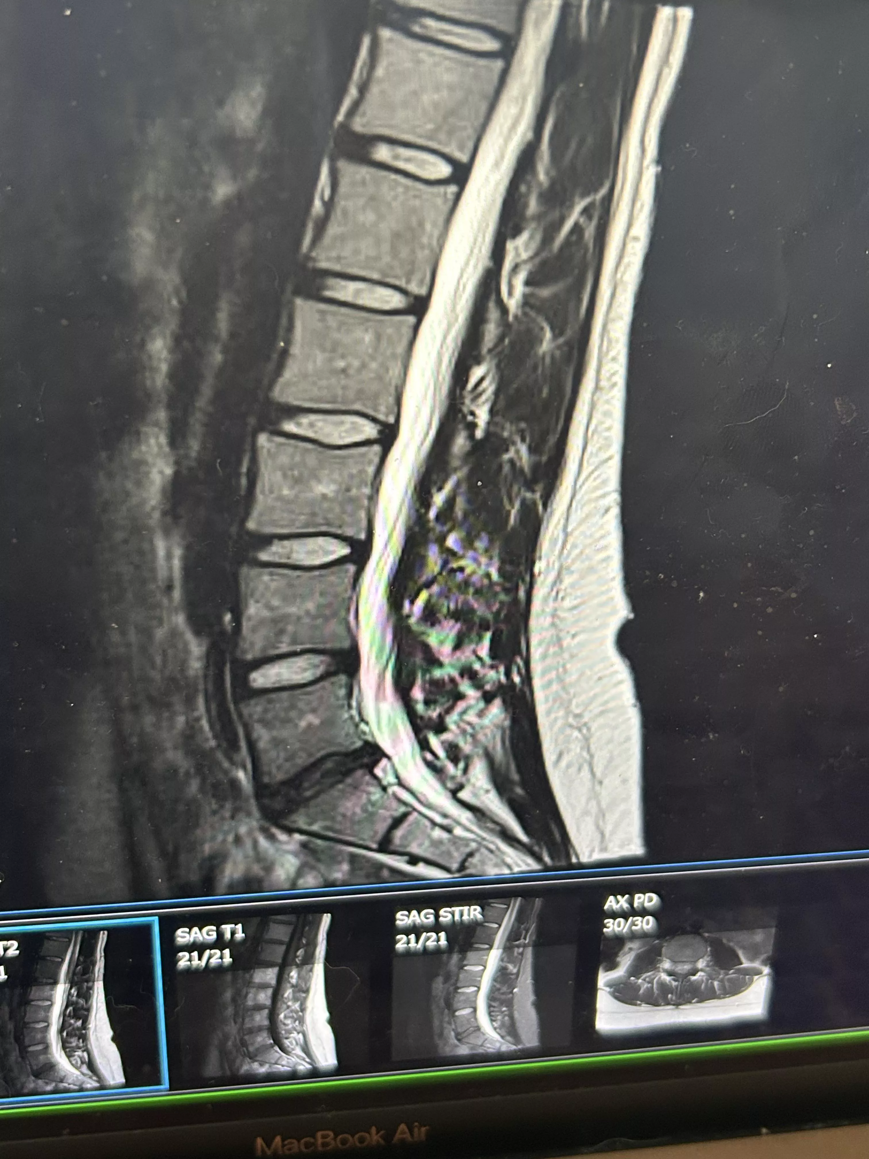 Is this bulging disc enough to cause significant pain and get a PT script