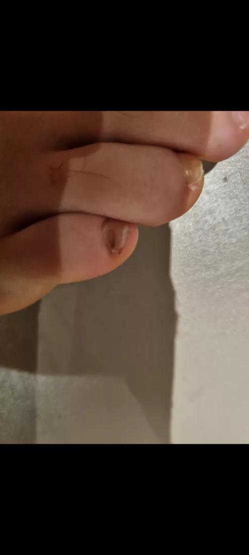 Weird blob in toenail. Don't recall hitting my toe.