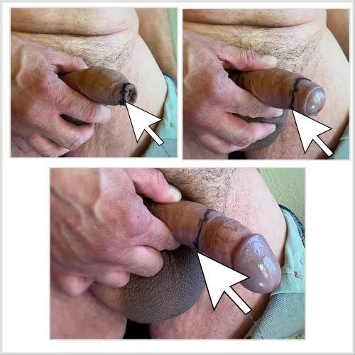 Black Line Indicates Movement Of The Foreskin Tip When Retracting