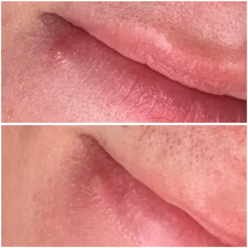 Cold sore or pimple? Developed over a week ago. 