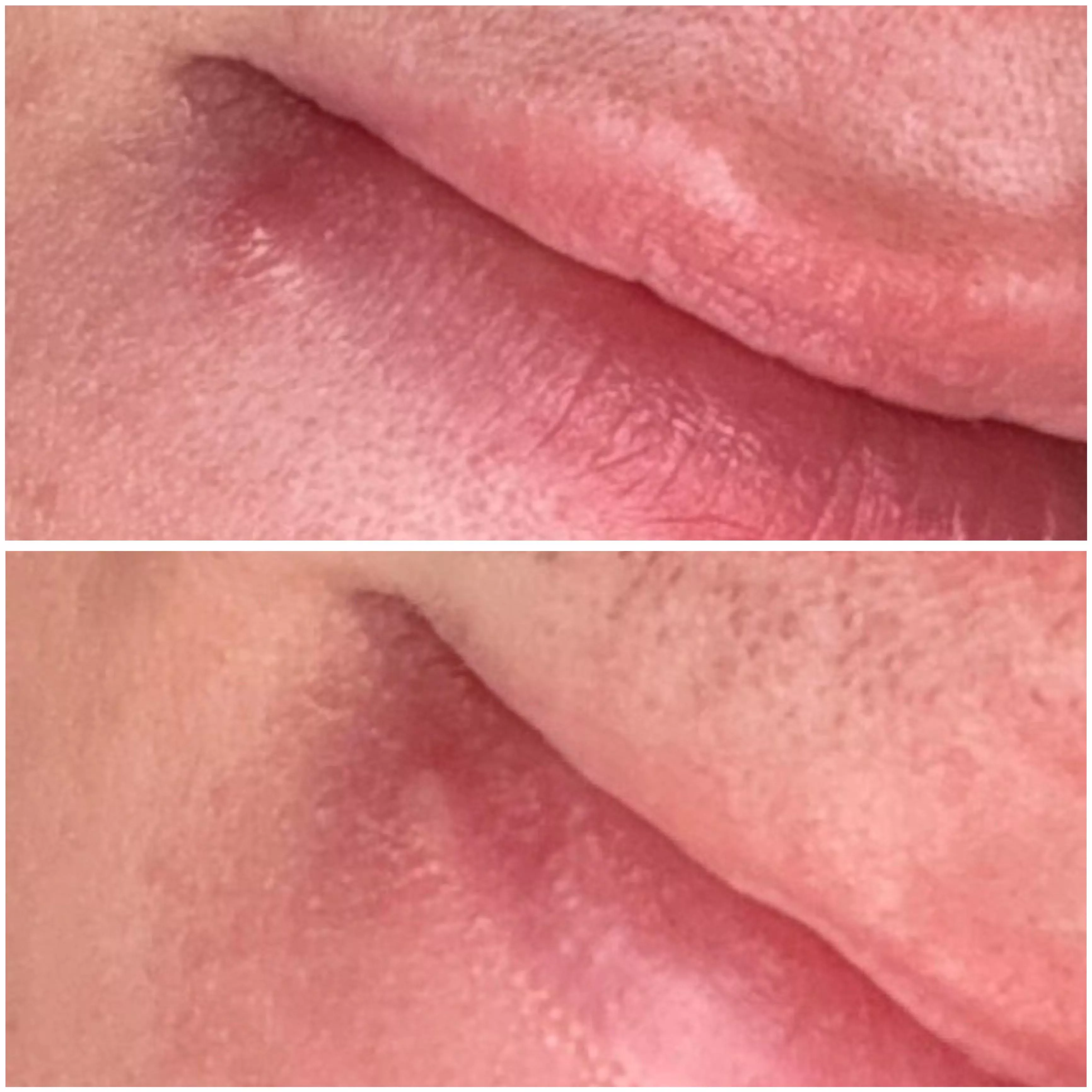 Cold sore or pimple? Developed over a week ago. 