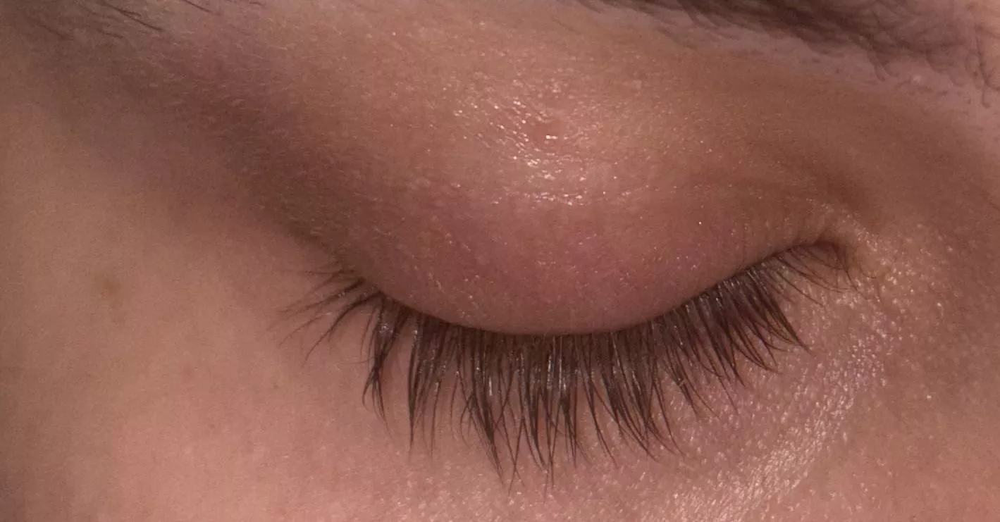Eyelid Swollen a bit and hurts when I close my eyes and squeeze