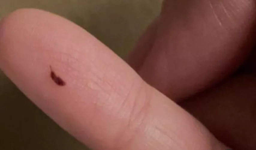 This appeared on my finger about a week ago. Should I be worried?