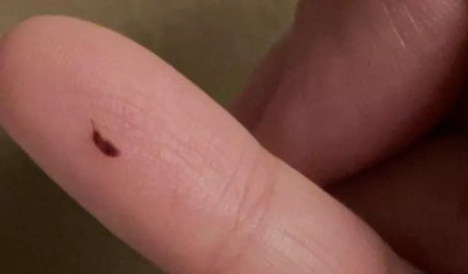 This appeared on my finger about a week ago. Should I be worried?
