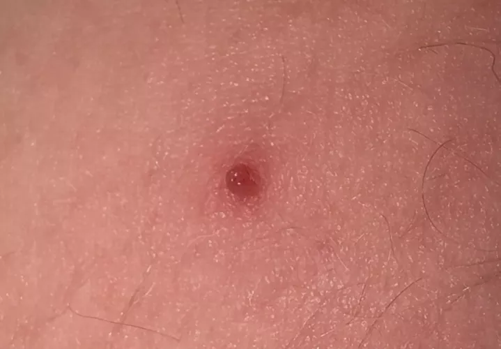 what is this little bump on my thigh?