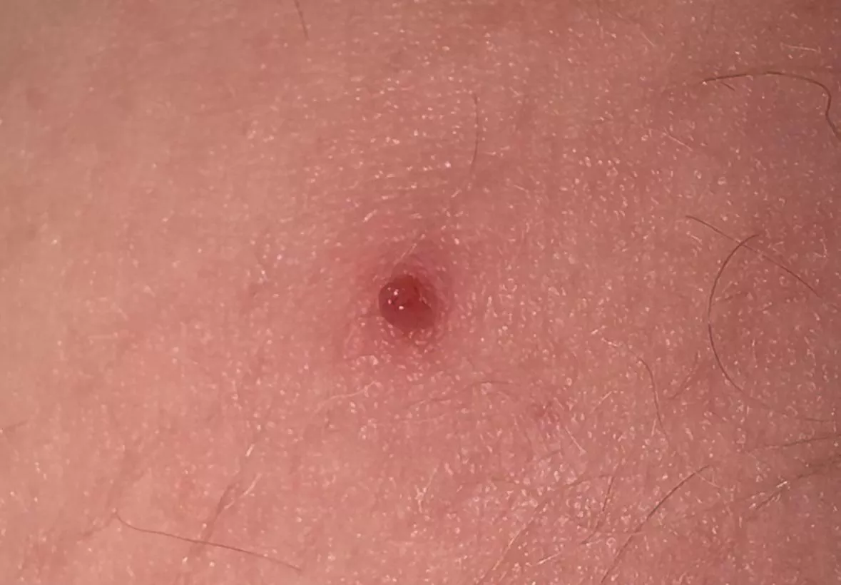 what is this little bump on my thigh?