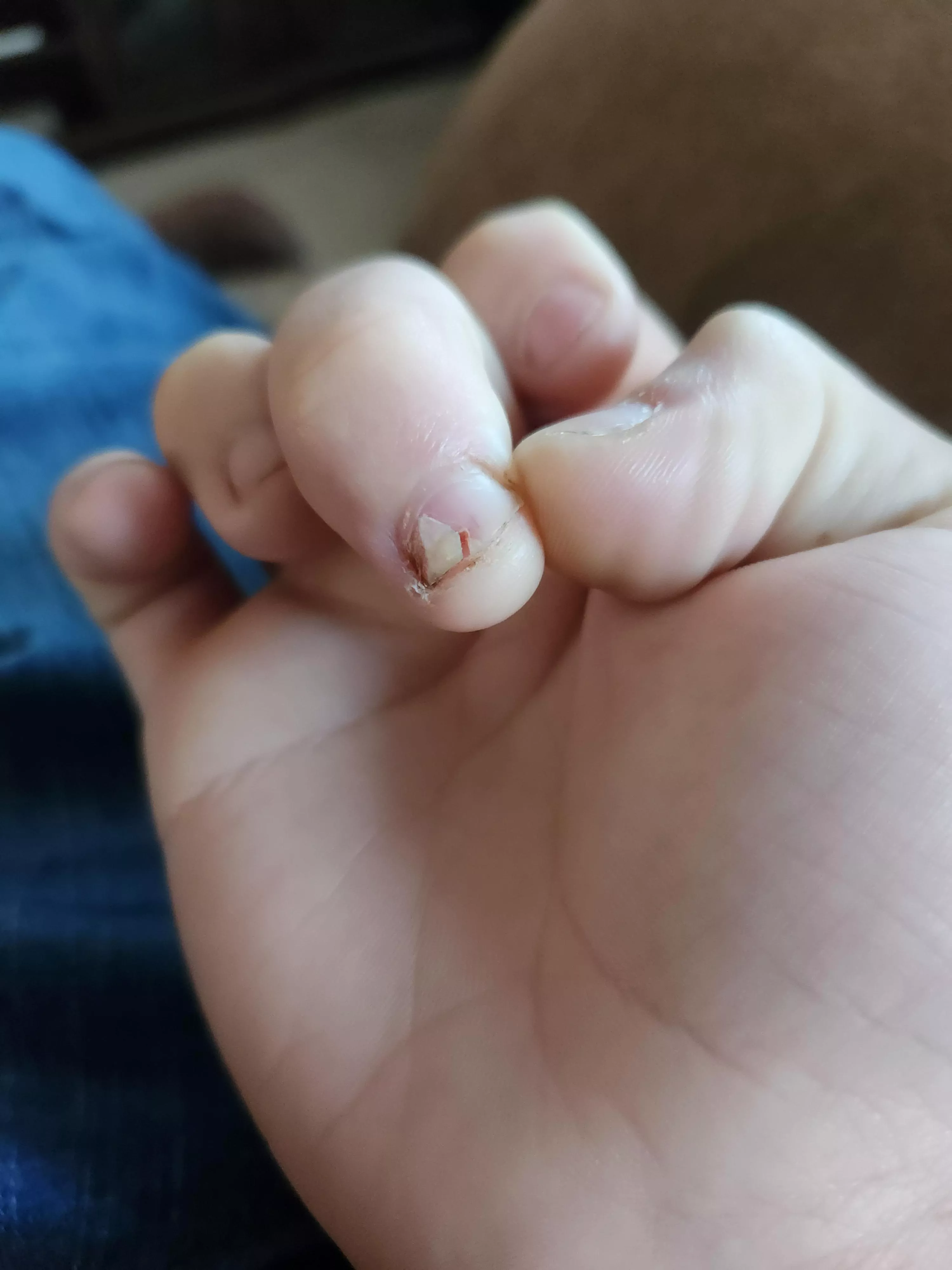 Broken my nail in a sink drain