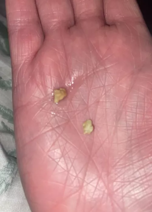 Huge Tonsil Stone