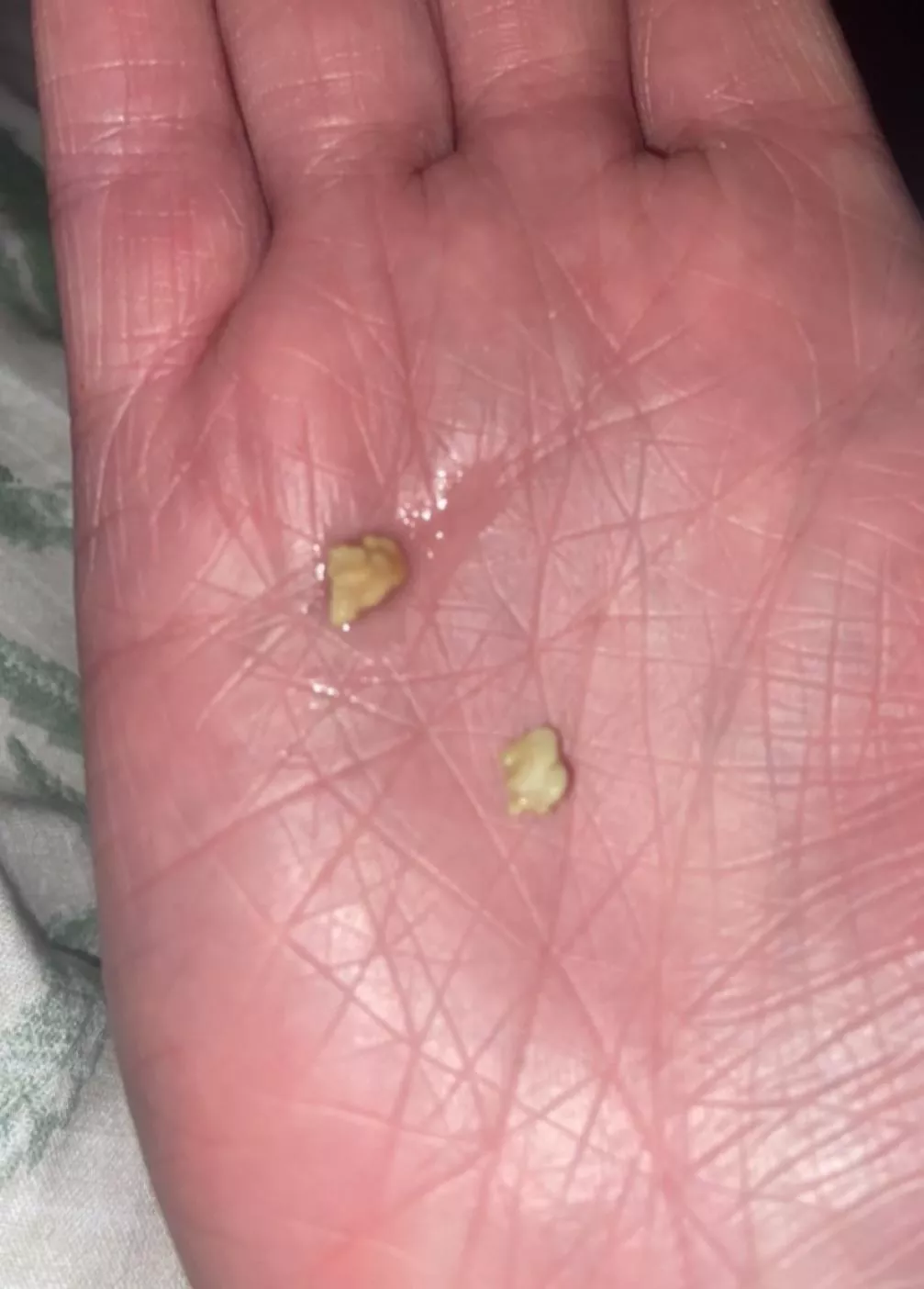 Huge Tonsil Stone
